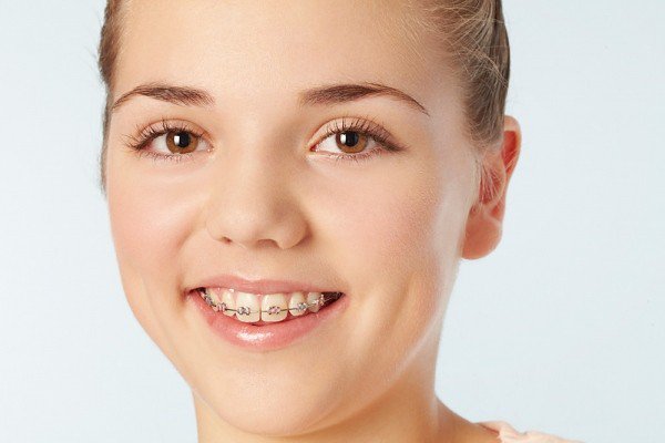 Thời gian niềng răng phụ thuộc vào mắc cài niềng răng