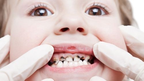 Dấu hiệu sâu răng ở trẻ