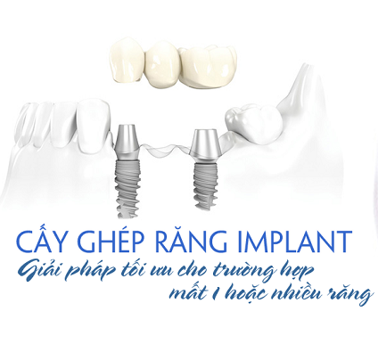 Cắm ghép Implant là gì?