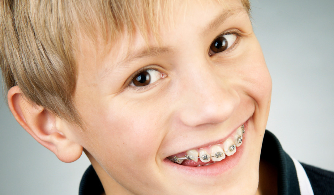 6-12 tuổi là thời gian tốt nhất để niềng răng
