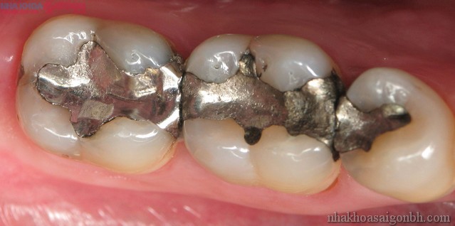 Phương pháp trám răng Amalgam