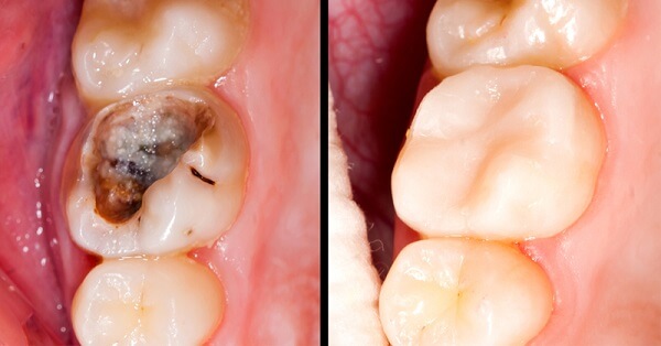 Trám răng sứ có đau không?