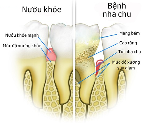 Bệnh nha chu có thể loại bỏ bằng cách làm sạch răng