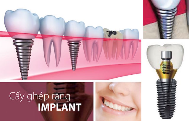 Chăm sóc răng miệng sau khi cắm ghép Implant