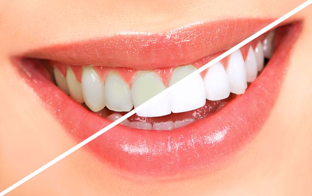 Tẩy trắng răng giúp răng trắng sáng thêm vài tông